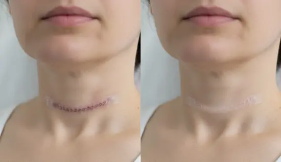 Tiroid Ameliyatı Sonrası Dikiş Alınır mı?